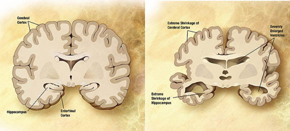 In the left normal brain, in the right brain of a person with Alzheimer's disease