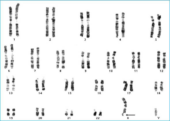 chromosome X