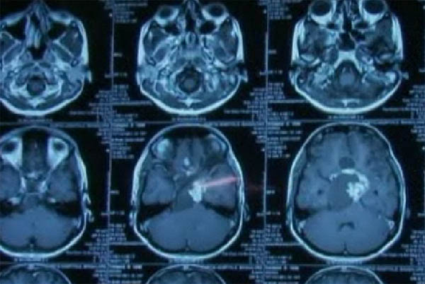 Imagerie du cerveau d'un patient atteint d'une tumeur au cerveau