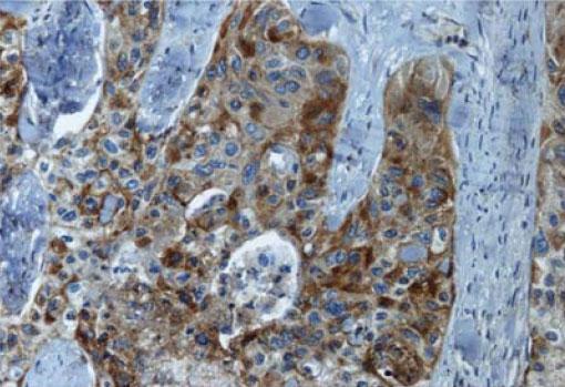 Adénocarcinome bronchique. Marquage du récepteur de la neurotensine 