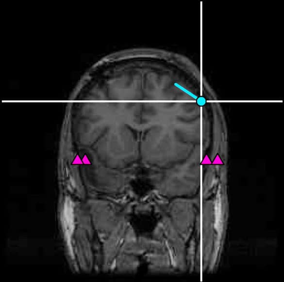 La MEG permet de voir le cerveau en action plutôt que d’en saisir une simple image. Le point bleu montre la zone active dans le cortex auditif d’une personne qui entend des sons.