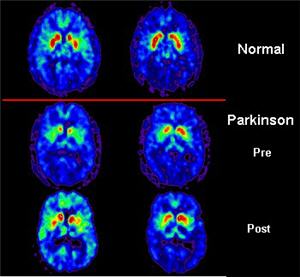 Scanner de cerveaux sains et atteints de la maladie de Parkinosn. Images © DR