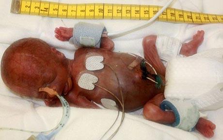A boy weighing only 275 grams after being born at University Hospital Goettingen in Germany is the world's lightest ever to have survived a premature birth Photo: EPA 