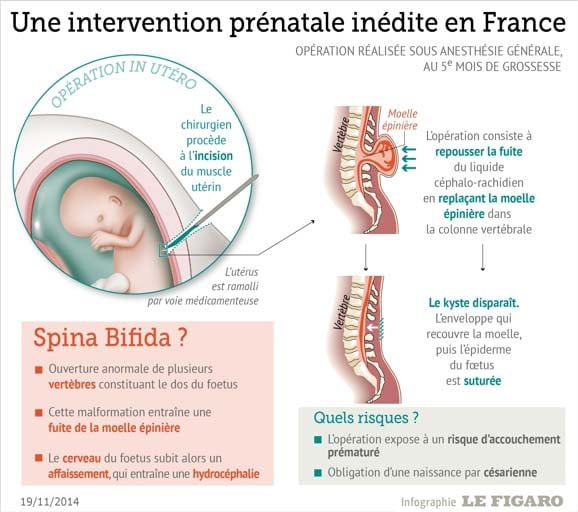 spina bifida